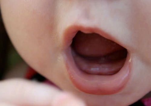 CÁCH TRỊ VIÊM LỢI Ở TRẺ SƠ SINH TẠI NHÀ AN TOÀN, HIỆU QUẢ 