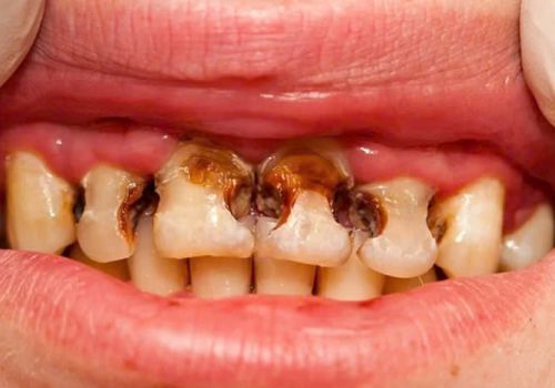 RĂNG SÂU Ở TRẺ EM – MỐI NGUY TIỀM ẨN CHO SỨC KHỎE TOÀN DIỆN CỦA BÉ
