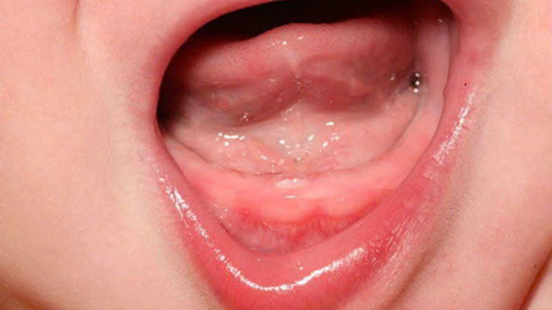 thiếu mầm răng  (2)