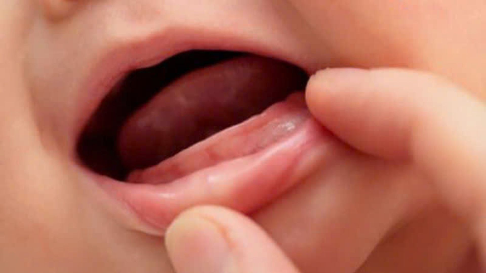 thiếu mầm răng  (3)