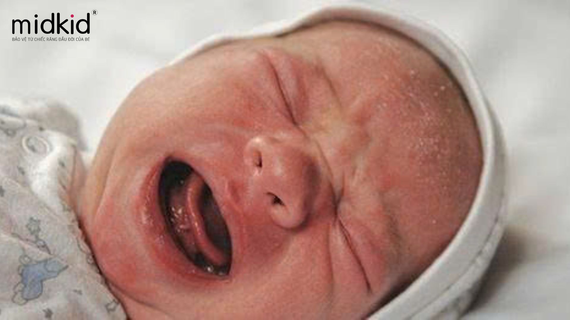 viêm lợi ở trẻ sơ sinh 